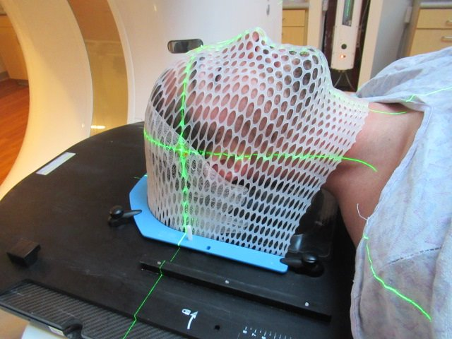 A patient on the radiotherapy couch with the rigid thermoplastic mesh mask bolted over their face under alignment lasers